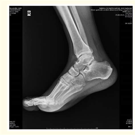 Preoperative Plain Ankle Lateral Radiography Download Scientific Diagram