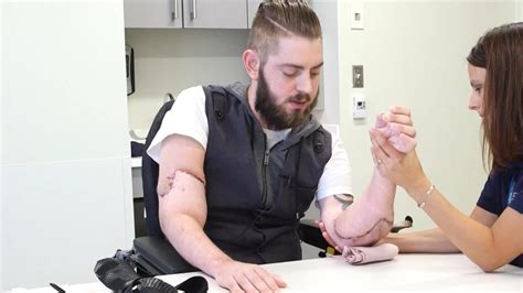 Veteran Receives One Of The Worlds First Double Arm Transplants