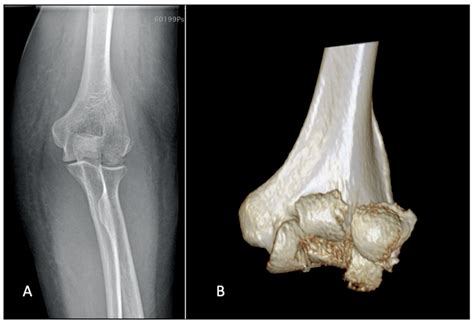 Jfmk Free Full Text Coronal Shear Fractures Of The Distal Humerus