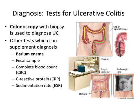 Ppt Ulcerative Colitis Powerpoint Presentation Free Download Id 1945751