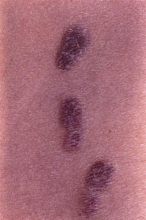 Kaposis Sarcoma Skin Plaques Photograph By Dr Ma Ansaryscience