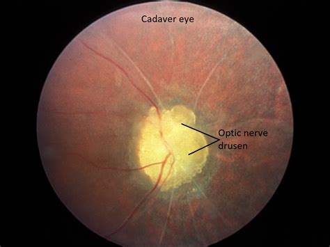 Moran Core Optic Nerve
