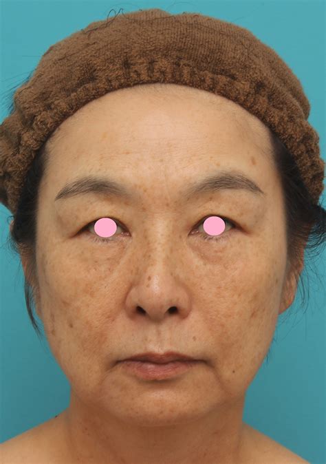 ミディアムフェイスリフトで頬のたるみをリフトアップさせた50代後半女性の症例写真です。 美容整形高須クリニック 高須 幹弥 オフィシャルブログ
