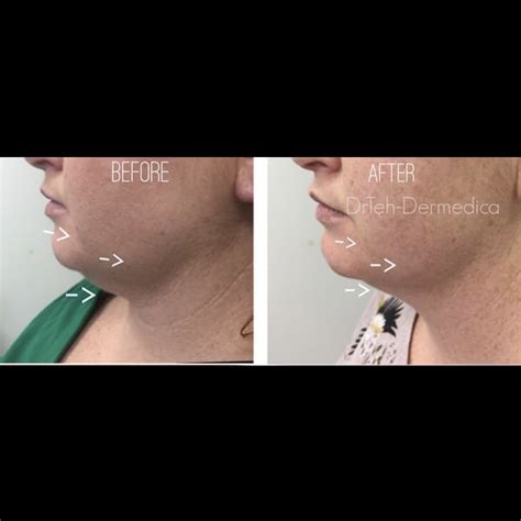 Coolsculpting For Double Chin Treatment Dermedica