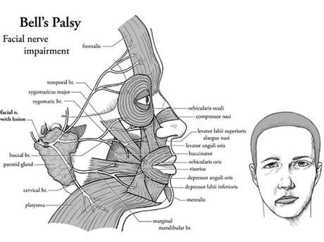 13 natural treatments for bell's palsy. Treatment for Bell's Palsy in Augusta GA - Paperblog