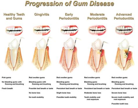 Diseases and pelvic inflammatory diseases. Gum Disease Treatment | Rancho Mirage Dentist | Palm ...