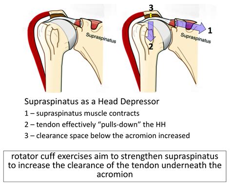 Rotator Cuff Supraspinatus Tendonitis Treatment Cambridge Shoulder