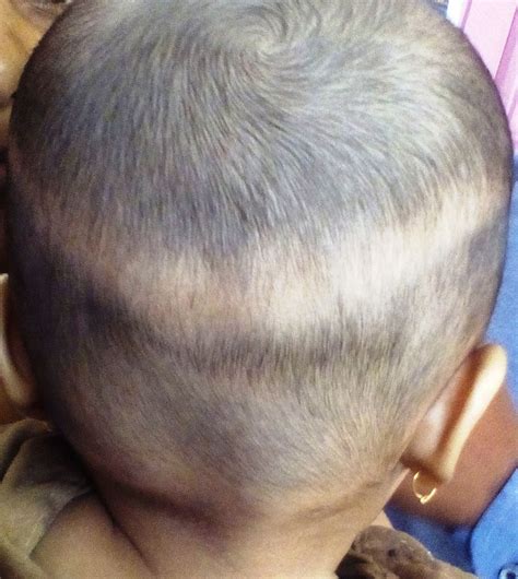 Three Month Old Infant With Band Like Hair Loss On The Occiput