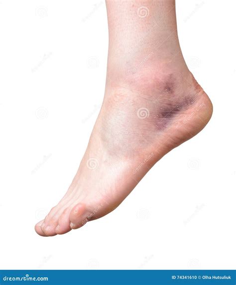 Sprained Ankle With Bruise And Swelling Female Foots Ankle Injury