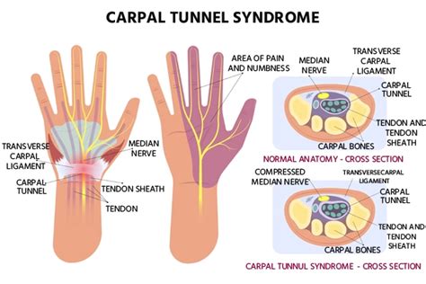 Carpal Tunnel Syndrome Symptoms And Treatment At Medicover
