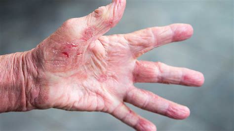 Scabies Rash On Hands