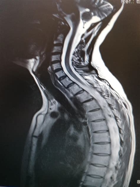 Herniated And Bulging Disc Diagnosis Causes And Treatments Mr Salus