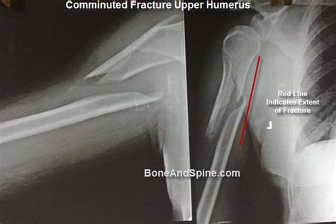 Upper Humerus Fracture