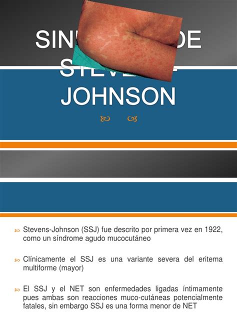Sindrome De Stevens Johnson Inmunología Drogas