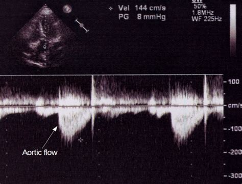 Aortic Flow Velocity By Doppler Echo All About Cardiovascular System