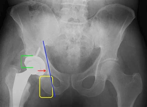 Classifications In Brief Paprosky Classification Of Acetabular Bone