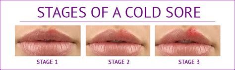 Canker And Cold Sores Which Act As Hot Sores Dr Nechupadam Dental Clinic