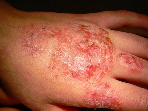 Alitretinoin An Effective Option In Children With Hand Eczema