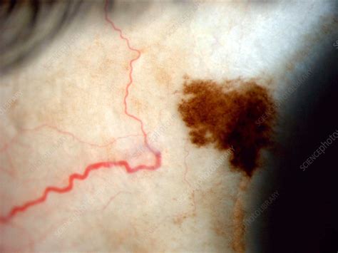 Scleral Nevus Stock Image C0271960 Science Photo Library