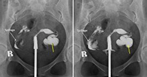 Hydrosalpinx Radiology Cases