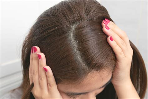 Dandruff Vs Dry Scalp 2024 Guide Differences Causes And Solutions