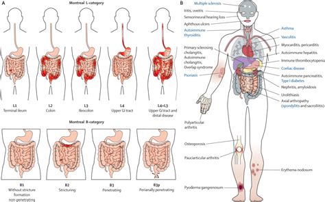 References In Crohns Disease The Lancet