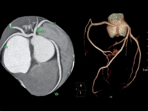 Angiotomografia Das Artérias Coronárias — Imagem