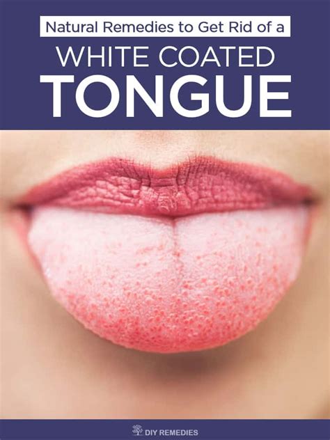 Natural Remedies To Get Rid Of A White Coated Tongue