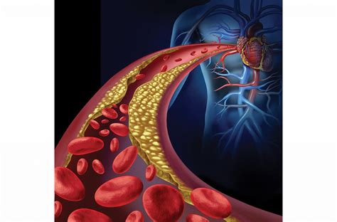 Enfermedad arterial coronaria no obstructiva Cómo diagnosticarla