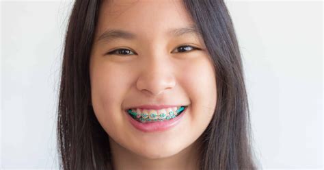 Orthodontics 101 Frequently Asked Questions About Braces Sensu