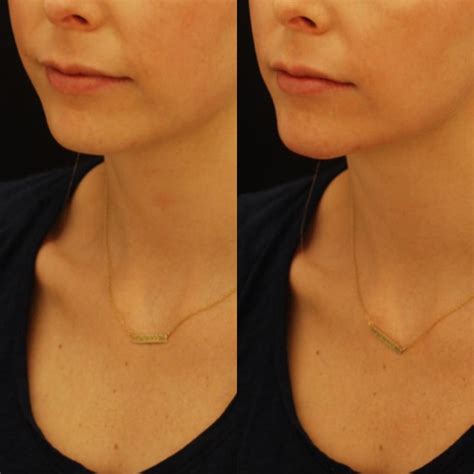 Chin Implant Before And After Stassi