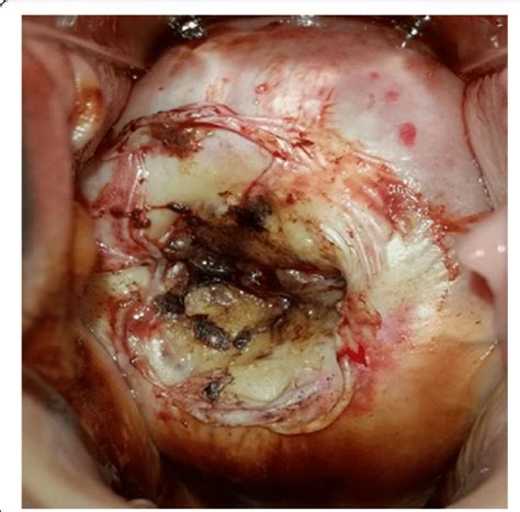 Picture of the cervix right after treatment with thermocoagulation ...