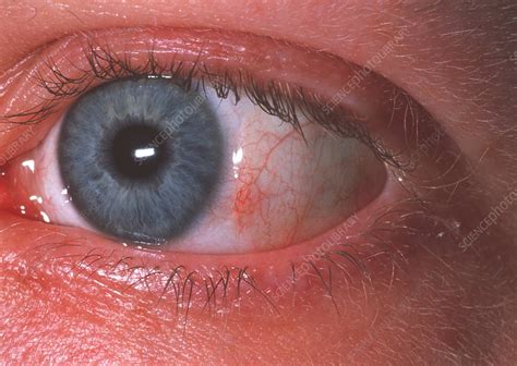 Eye Scar Stock Image M1550444 Science Photo Library