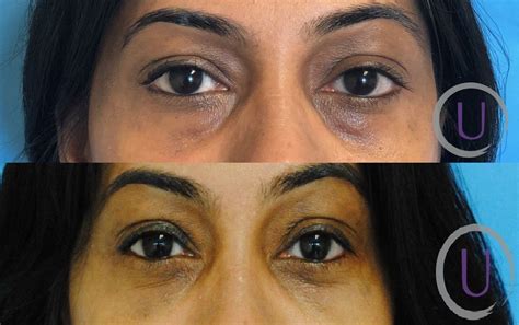 Filler For Tear Trough Botox Fillers Tear Trough Botox Injections