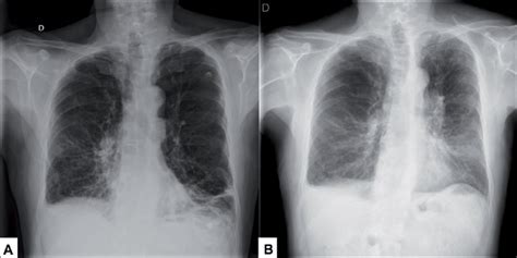 Radiografía De Tórax De Paciente Con Epoc A Hiperinsuflación Pulmonar