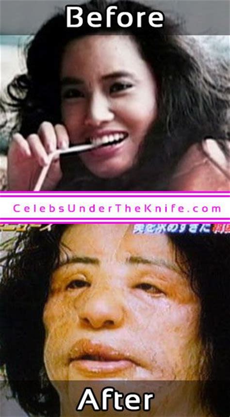 Terrifying Plastic Surgery Before After Photos