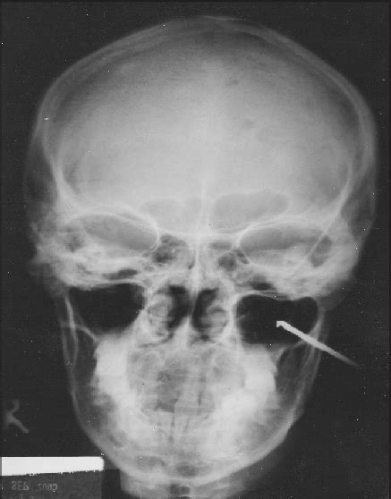 X Ray AP View Showing An Arrow Lodged In The Left Maxillary Sinus Download Scientific Diagram