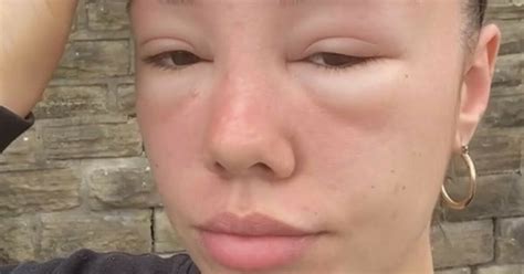 British Woman Suffers Severe Sunburn And Eye Swelling After Using