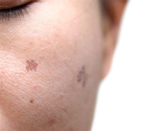 Age Spots Brown Spots And Freckles Dermatology Laser And Vein