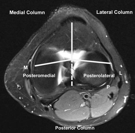 Three Column Classification System For Tibial Plateau Fractures What