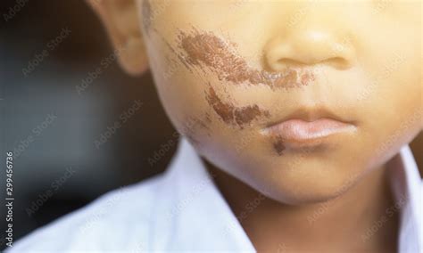 Dry Scab Scar Wound On Kid Face From Hard Accident Foto De Stock