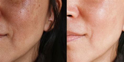 The kind of floaters that may indicated posteriors if your black spots don't vanish quickly then you need an emergency appointment with an optician; What You Should Know About Melasma, Those Dark Spots on ...
