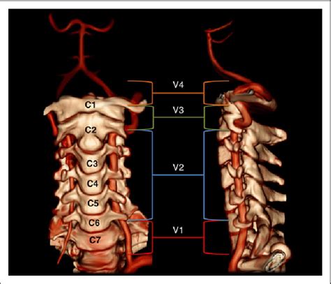 Vertebral Artery Segments V1 Through V4 Case Courtesy Of Dr Robert