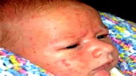 Baby Acne Treatment Get Rid Of Acne Youtube