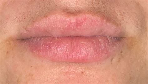 What Does An Allergic Reaction On Lips Look Like