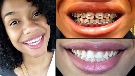 How Long Does It Take To Have Braces Taken Off Reverasite