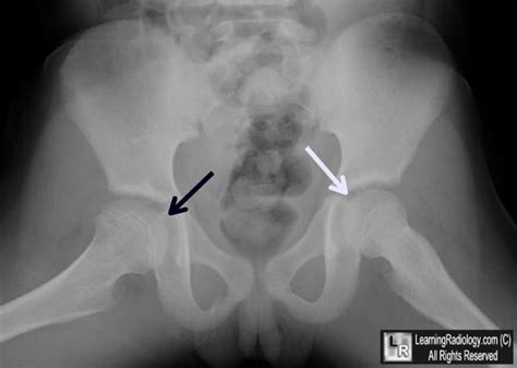 Legg Calve Perthes Disease View Of Both Hips Shows A Right Capital