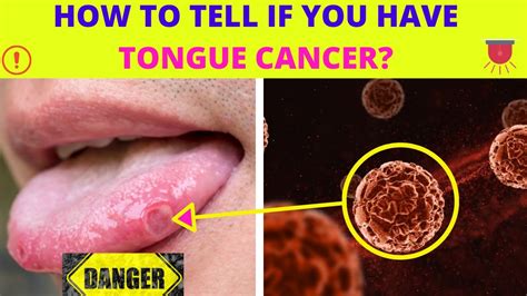 Early Signs And Symptoms Of Tongue Cancer ~ How To Tell If You Have