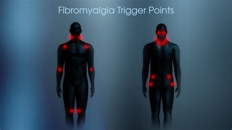 Fibromyalgia Symptoms Causes And Treatments Scientific Animations