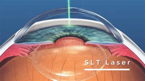 Selective Laser Trabeculoplasty Slt
